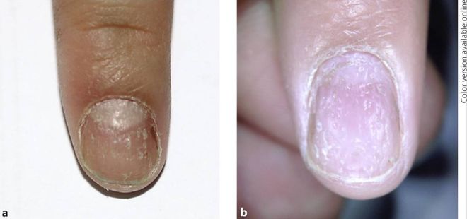 孩子指甲軟薄易斷、月牙少、長(zhǎng)白點(diǎn)、豎紋是顯示身體有健康風(fēng)險(xiǎn)嗎？(圖7)