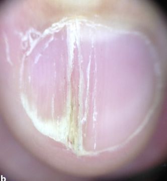 孩子指甲軟薄易斷、月牙少、長(zhǎng)白點(diǎn)、豎紋是顯示身體有健康風(fēng)險(xiǎn)嗎？(圖11)