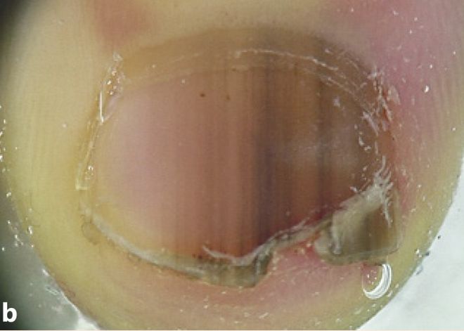 孩子指甲軟薄易斷、月牙少、長(zhǎng)白點(diǎn)、豎紋是顯示身體有健康風(fēng)險(xiǎn)嗎？(圖8)