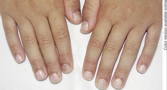 孩子指甲軟薄易斷、月牙少、長(zhǎng)白點(diǎn)、豎紋是顯示身體有健康風(fēng)險(xiǎn)嗎？(圖10)