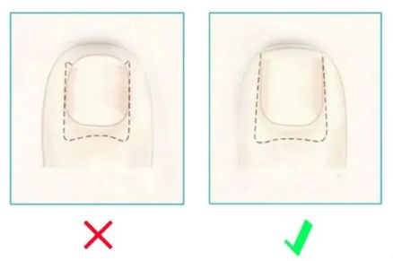 孩子指甲軟薄易斷、月牙少、長(zhǎng)白點(diǎn)、豎紋是顯示身體有健康風(fēng)險(xiǎn)嗎？(圖13)